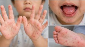 niño pequeño que presenta el virus Coxsackie