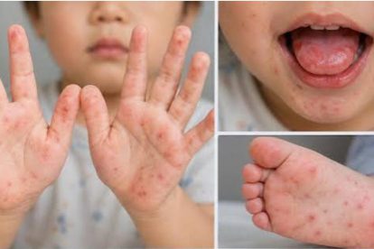 niño pequeño que presenta el virus Coxsackie