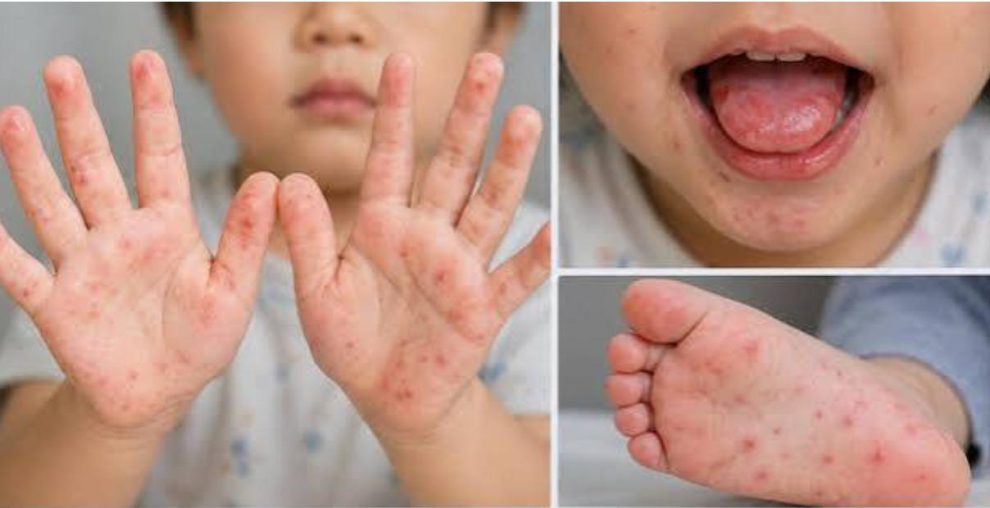 niño pequeño que presenta el virus Coxsackie